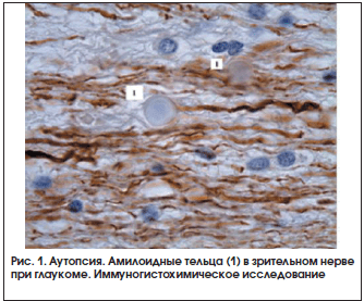 Рис. 1. Аутопсия. Амилоидные тельца (1) в зрительном нерве при глаукоме. Иммуногистохимическое исследование