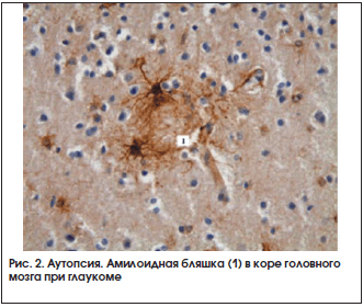 Рис. 2. Аутопсия. Амилоидная бляшка (1) в коре головного мозга при глаукоме