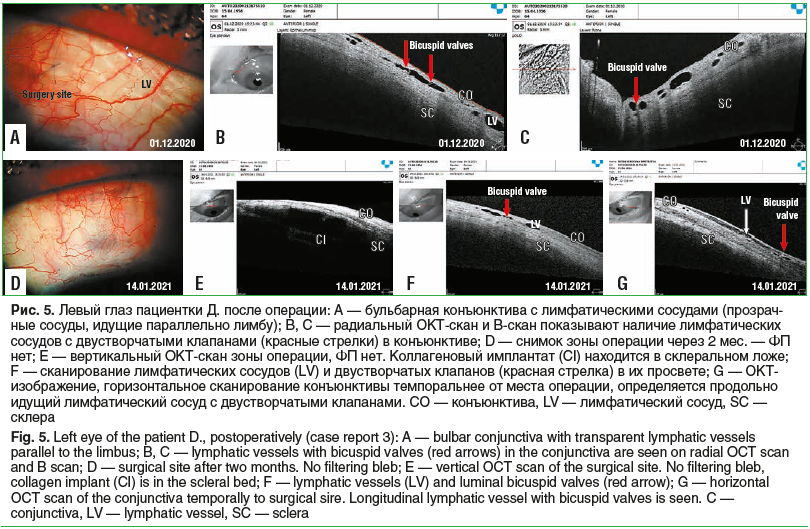 Рис. 5. Левый глаз пациентки Д. после операции: A — бульбарная конъюнктива с лимфатическими сосудами (прозрач- ные сосуды, идущие параллельно лимбу); B, C — радиальный ОКТ-скан и B-скан показывают наличие лимфатических сосудов с двустворчатыми клапанами (