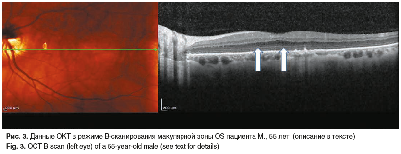 Рис. 3. Данные ОКТ в режиме B-сканирования макулярной зоны OS пациента М., 55 лет (описание в тексте) Fig. 3. OCT B scan (left eye) of a 55-year-old male (see text for details)